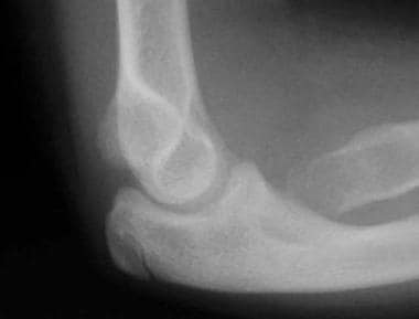 Lateral radiograph of elbow of patient A, depictin