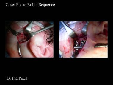 Intraoperative photographs of distractor placement