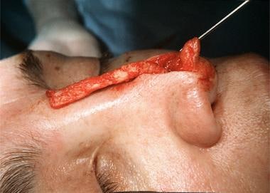 Rib cartilage graft and Proplast bridge graft. A 4