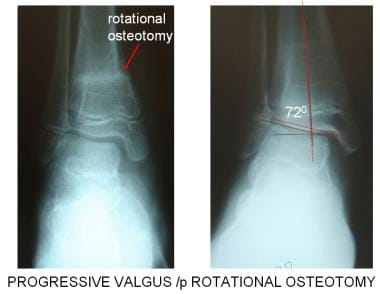 Pediatric Ankle Valgus: Background, Anatomy, Pathophysiology