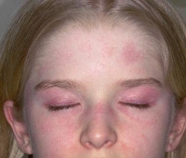 Juvenile Dermatomyositis Background Pathophysiology Etiology