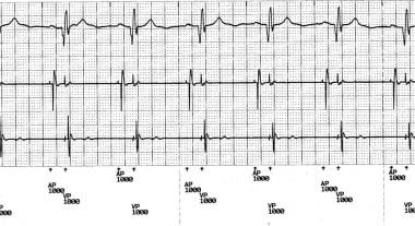 Telemetered ECG tracing showing atrioventricular (