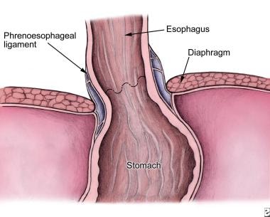 Relationship of the phrenoesophageal ligament to t