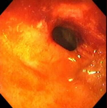 Inflammatory bowel disease. Stricture in the termi