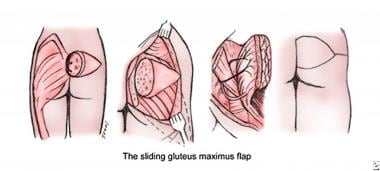 Pressure Injuries (Pressure Ulcers) and Wound Care: Practice Essentials,  Background, Anatomy