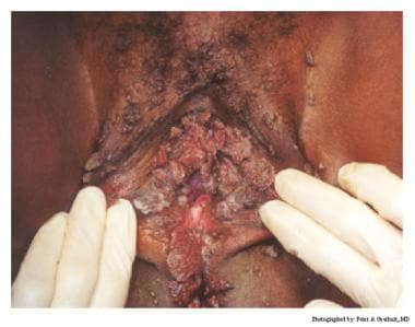 Human papillomavirus (HPV). Note the extensive lab