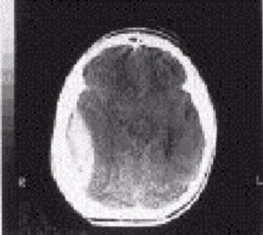 CT scan showing a lenticular-shaped intracranial e