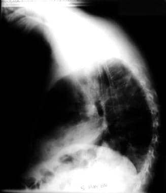 Lateral chest radiograph reveals the ill-defined l