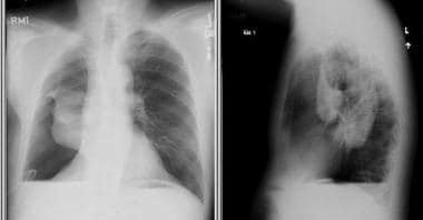 Pleural Effusion ~ JPEEI CLINIC