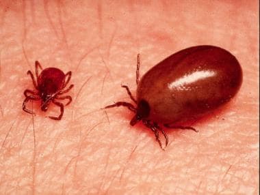 Lyme disease. Normal and engorged Ixodes ticks. 