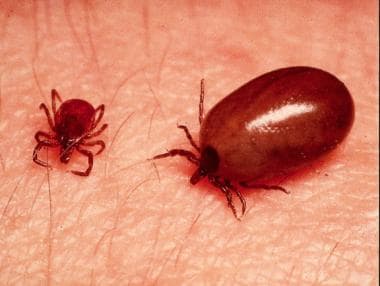 莱姆病。Normal and engorged Ixodes ticks.