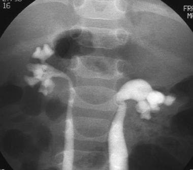 Voiding cystourethrogram from the same patient (in