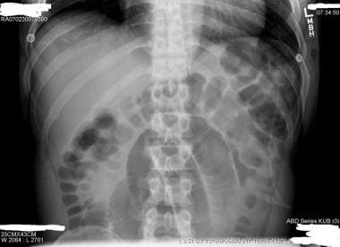 small bowel obstruction