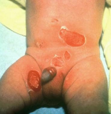 Staphylococcal scalded skin syndrome. Photograph b