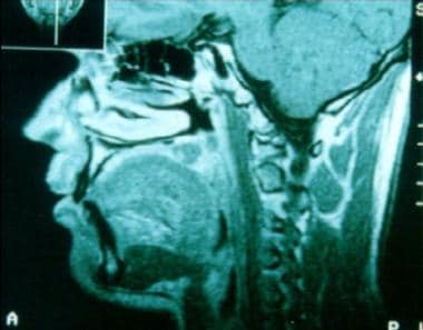 Sagittal MRI revealing a mass confined to the pala