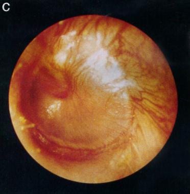 Tympanic membrane of a person with 12 hours of ear