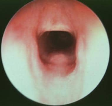 Preoperative frontal view that demonstrates a red, round bulge in the