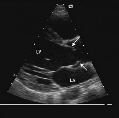 Parasternal long-axis echocardiogram showing domin