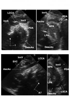 Interrupted Aortic Arch Background Pathophysiology Etiology