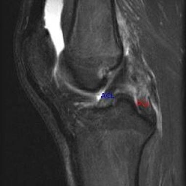 This MRI of the knee shows a torn posterior crucia