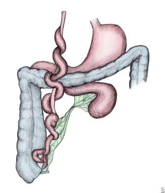 Small Intestinal Atresia and Stenosis: Practice Essentials,  Pathophysiology, Etiology