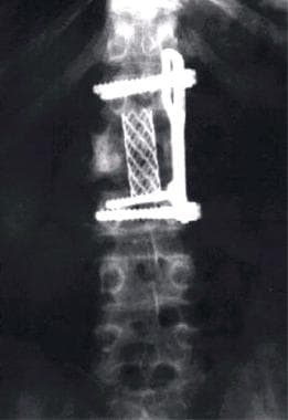 Postoperative plain x-ray film of a professional d