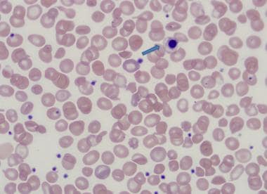 Nucleated red blood cell in thalassemia intermedia