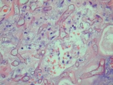 Mucormycosis with broad, aseptate hyphae (hematoxy