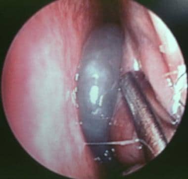 Rigid endoscopic view of the left anterior nasal c