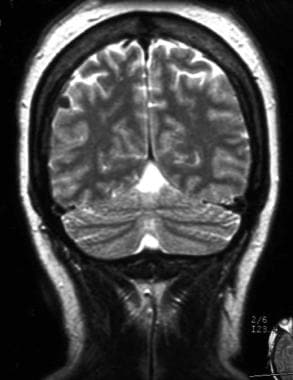 Case 2: MRI of a 40-year-old patient with a single