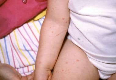 urticaria