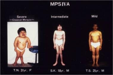 Clinical pictures of patients with Morquio A syndr