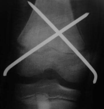 Growth plate (physeal) fractures. Anatomic reducti