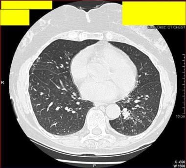 CT thorax scan of a 77-year-old woman who presente
