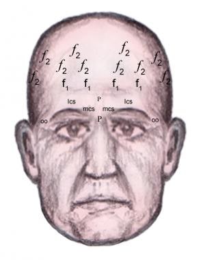 Frontal injection sites. 