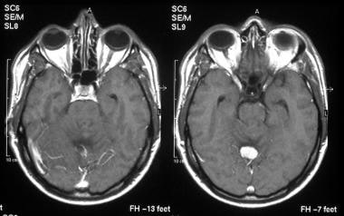 T1-weighted, transaxial, gadolinium-enhanced magne