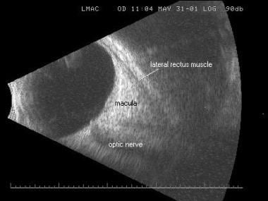 Longitudinal macular scan in an eye with macular e