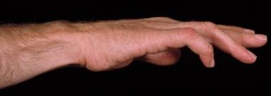 Preoperative photo of a hand with claw deformity. 