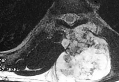 Spinal tumors. T2-weighted MRI scan of chondrosarc