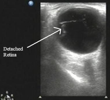 Ultrasound image demonstrating a retinal detachmen