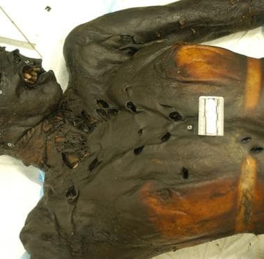 Mummification of this homicide victim occurred aft