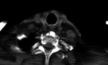 Computed tomography fluoroscopic image shows the c