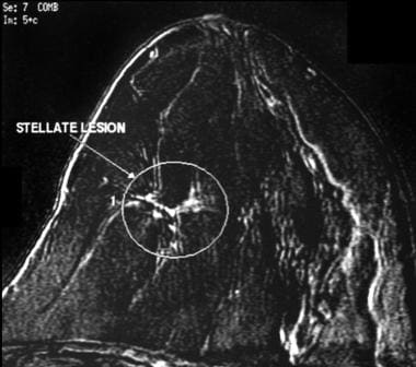 This lesion is seen as a stellate, modestly enhanc
