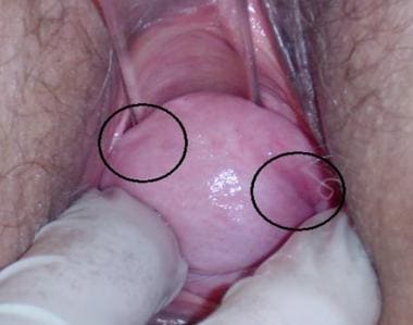 Cystocele and vault prolapse with visible dimples.