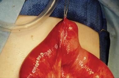 Intraoperative photograph of Meckel diverticulum. 