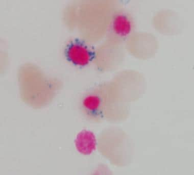 sideroblastic anemia pathophysiology