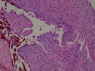 Nonspecific granulomatous prostatitis. Epithelium 