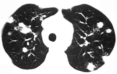 Chest CT image of pulmonary coccidioidomycosis. (C
