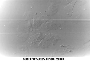 Infertility. Clear preovulatory cervical mucus. Im