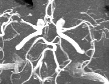 TOF MRA demonstrates an occlusion or high-grade st